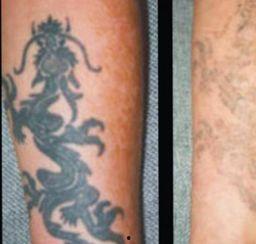 洗纹身前后照片,洗纹身前后对比，见证美丽重生